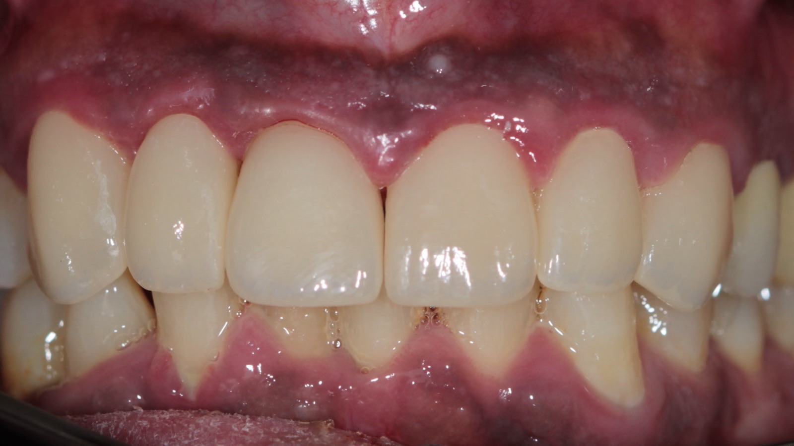 Sonrisa después del tratamiento con carillas en Clínica Dental Gálvez