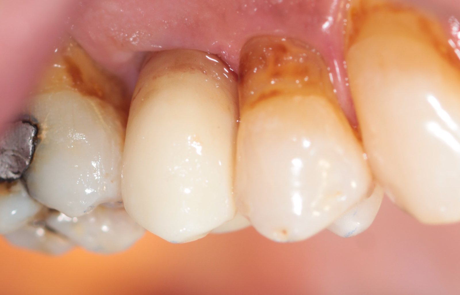 Diente restaurado con implante y corona en Clínica Dental Gálvez