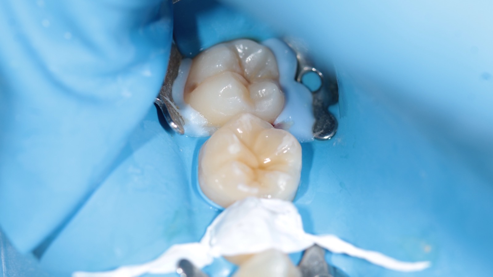 Diente restaurado con incrustación de composite en Clínica Dental Gálvez
