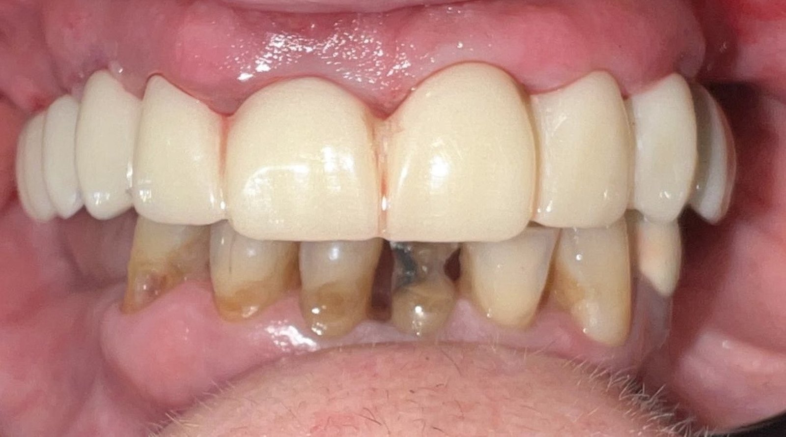 Prótesis fija superior sobre implantes colocada el mismo día en Clínica Dental Gálvez