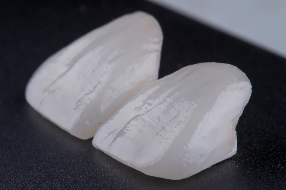 Carillas de cerámica para diseño de sonrisa